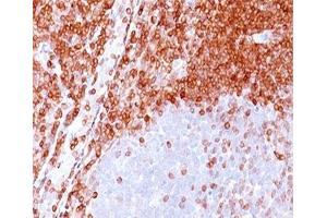 IHC testing of formalin-paraffin non-Hodgkin's lymphoma stained with Bcl-2 antibody (100/D5). (Bcl-2 抗体)