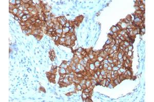 Formalin-fixed, paraffin-embedded human Breast Carcinoma stained with HER-2 Monospecific Mouse Monoclonal Antibody (ERBB2/3257). (ErbB2/Her2 抗体  (AA 311-462))