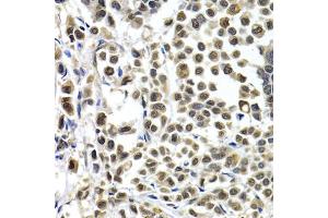 Immunohistochemistry of paraffin-embedded human breast cancer using IRF2 antibody. (IRF2 抗体)