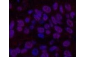 Immunofluorescence analysis of Human lung cancer tissue using Transferrin Monoclonal Antibody at dilution of 1:200. (Transferrin 抗体)