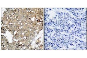 Immunohistochemical analysis of paraffin-embedded human breast carcinoma tissue using STAT1 (Ab-727) antibody (E021177). (STAT1 抗体)