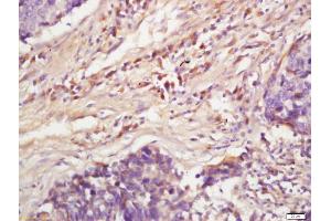 Formalin-fixed and paraffin embedded human lung carcinoma labeled with Anti-Phospho-MAPKAPK2(Ser272)Polyclonal Antibody, Unconjugated (ABIN710531) at 1:200, followed by conjugation to the secondary antibody and DAB staining (MAPKAP Kinase 2 抗体  (pSer272))