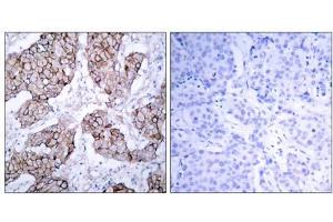 Immunohistochemical analysis of paraffin- embedded human breast carcinoma tissue using (EGFR 抗体  (pTyr1092))