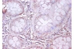 Immunohistochemistry of paraffin-embedded human colon cancer using ABIN7144046 at dilution of 1:100 (APP 抗体  (AA 18-664))