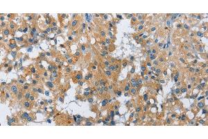 Immunohistochemistry of paraffin-embedded Human thyroid cancer using FGF9 Polyclonal Antibody at dilution of 1:40 (FGF9 抗体)