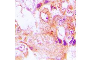 Immunohistochemical analysis of ABHD9 staining in human lung cancer formalin fixed paraffin embedded tissue section. (ABHD9 抗体  (Center))