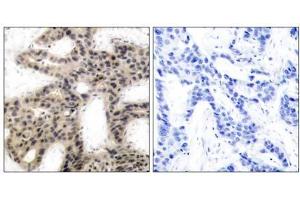 Immunohistochemical analysis of paraffin-embedded human breast carcinoma tissue using 4E-BP1 (phospho-Thr45) antibody (E011223). (eIF4EBP1 抗体  (pThr45))