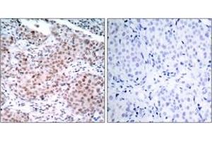 Immunohistochemistry analysis of paraffin-embedded human breast carcinoma, using Estrogen Receptor-alpha (Phospho-Ser104) Antibody. (Estrogen Receptor alpha 抗体  (pSer104))