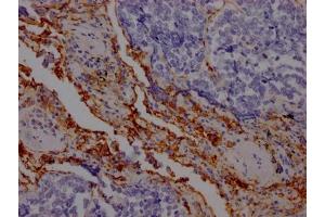 IHC image of ABIN7127559 diluted at 1:100 and staining in paraffin-embedded human lung cancer performed on a Leica BondTM system. (Recombinant ICAM1 抗体)