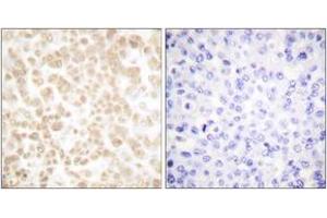 Immunohistochemistry analysis of paraffin-embedded human breast carcinoma tissue, using Fra-2 Antibody. (FOSL2 抗体  (AA 271-320))