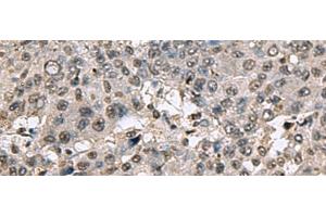 Immunohistochemistry of paraffin-embedded Human liver cancer tissue using TMX3 Polyclonal Antibody at dilution of 1:70(x200) (TMX3 抗体)