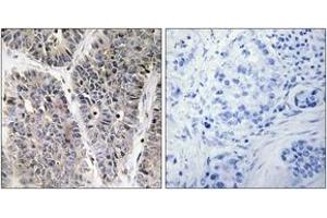 Immunohistochemistry analysis of paraffin-embedded human lung carcinoma tissue, using NBL1 Antibody. (NBL1 抗体  (AA 131-180))
