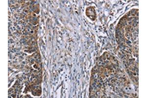 The image on the left is immunohistochemistry of paraffin-embedded Human esophagus cancer tissue using ABIN7191114(IQCJ Antibody) at dilution 1/30, on the right is treated with synthetic peptide. (IQCJ 抗体)