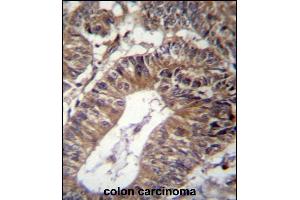 GCC1 Antibody (C-term) (ABIN656908 and ABIN2846105) immunohistochemistry analysis in formalin fixed and paraffin embedded human colon carcinoma followed by peroxidase conjugation of the secondary antibody and DAB staining. (GCC1 抗体  (C-Term))