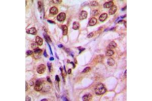 Immunohistochemical analysis of 4EBP1 staining in human breast cancer formalin fixed paraffin embedded tissue section. (eIF4EBP1 抗体  (Center))