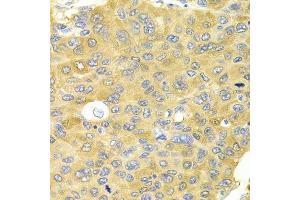 Immunohistochemistry of paraffin-embedded human liver cancer using PA2G4 Antibody. (PA2G4 抗体  (AA 1-394))