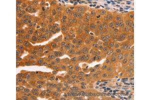 Immunohistochemistry of Human ovarian cancer using SERPINB5 Polyclonal Antibody at dilution of 1:60 (SERPINB5 抗体)