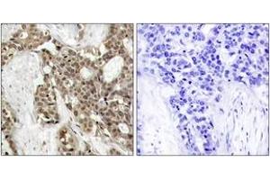Immunohistochemistry analysis of paraffin-embedded human breast carcinoma, using p44/42 MAP Kinase (Phospho-Tyr204) Antibody. (ERK1/2 抗体  (pTyr204))