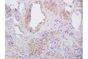 Formalin-fixed and paraffin embedded human cervical carcinoma labeled with Rabbit Anti phospho-CXCR4(Ser339) Polyclonal Antibody, Unconjugated (ABIN1714582) at 1:200 followed by conjugation to the secondary antibody and DAB staining (CXCR4 抗体  (pSer339))