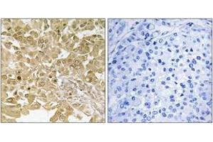 Immunohistochemistry analysis of paraffin-embedded human breast carcinoma tissue, using MEK1 (Ab-291) Antibody. (MEK1 抗体  (AA 261-310))