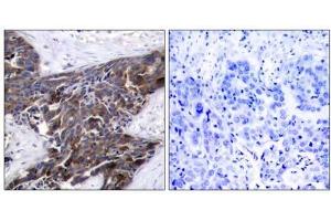 Immunohistochemical analysis of paraffin-embedded human breast carcinoma tissue using Connexin43 (phospho-Ser367) antibody (E011258). (Connexin 43/GJA1 抗体  (pSer367))