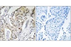 Immunohistochemistry analysis of paraffin-embedded human breast carcinoma tissue, using POLE4 Antibody. (POLE4 抗体  (AA 61-110))