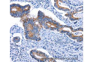 Immunohistochemistry of Human colon cancer using STAT5A Polyclonal Antibody at dilution of 1:25 (STAT5A 抗体)