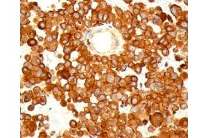 IHC testing of human melanoma stained with CD63 antibody (MX49. (CD63 抗体)