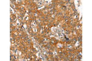 Immunohistochemistry (IHC) image for anti-Matrix Metalloproteinase 2 (MMP2) antibody (ABIN2434292) (MMP2 抗体)