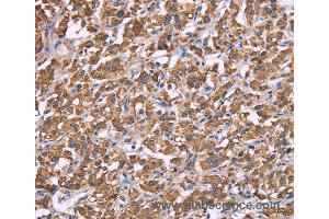 Immunohistochemistry of Human thyroid cancer using HSPE1 Polyclonal Antibody at dilution of 1:40 (HSPE1 抗体)
