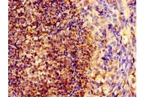 Immunohistochemistry of paraffin-embedded human ovarian cancer using ABIN7161294 at dilution of 1:100 (Notch1 抗体  (AA 2428-2555))