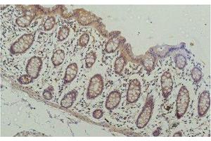 Immunohistochemistry of paraffin-embedded Human colon carcinoma tissue using HDAC1 Monoclonal Antibody at dilution of 1:200. (HDAC1 抗体)