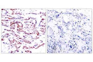 Immunohistochemical analysis of paraffin-embedded human breast carcinoma tissue using ATF-2 (phospho-Thr71 or 53) antibody (E011031). (ATF2 抗体  (pThr53, pThr71))