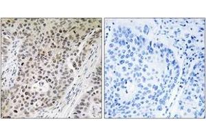 Immunohistochemistry analysis of paraffin-embedded human lung carcinoma tissue, using ZNF608 Antibody. (ZNF608 抗体  (AA 1231-1280))