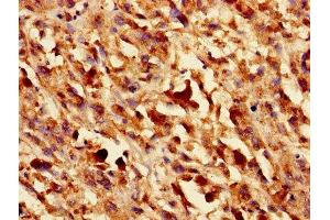 Immunohistochemistry of paraffin-embedded human melanoma using ABIN7153440 at dilution of 1:100 (LGALS1/Galectin 1 抗体  (AA 2-135))