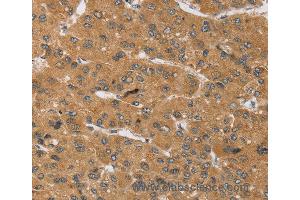 Immunohistochemistry of Human cervical cancer using KCNJ15 Polyclonal Antibody at dilution of 1:40 (KCNJ15 抗体)