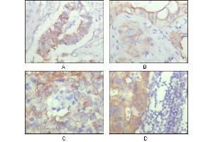Immunohistochemical analysis of paraffin-embedded human ovary carcinoma (A), kidney carcinoma (B), lung carcinoma (C) and breast carcinoma (D), showing cytoplasmic and membrane localization with DAB staining using ALCAM mouse mAb. (CD166 抗体)