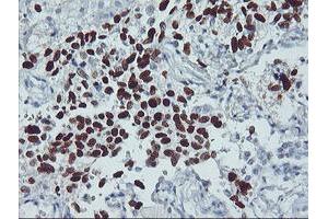 Immunohistochemical staining of paraffin-embedded Carcinoma of Human lung tissue using anti-TP53 mouse monoclonal antibody. (p53 抗体)