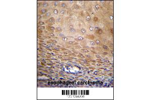 TMEM43 Antibody immunohistochemistry analysis in formalin fixed and paraffin embedded human esophageal carcinoma followed by peroxidase conjugation of the secondary antibody and DAB staining. (TMEM43 抗体  (AA 195-223))