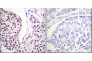 Immunohistochemistry analysis of paraffin-embedded human breast carcinoma tissue, using Histone H4 (Ab-8) Antibody. (Histone H4 抗体  (AA 6-55))