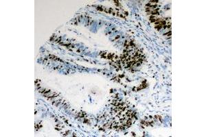 Immunohistochemical analysis of Cyclin E1 (pT395) staining in human colon cancer formalin fixed paraffin embedded tissue section. (Cyclin E1 抗体  (C-Term, pSer395))
