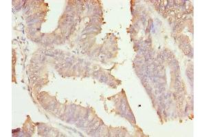 Immunohistochemistry of paraffin-embedded human endometrial cancer using ABIN7166006 at dilution of 1:100 (RER1 抗体  (AA 85-139))