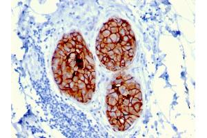 Formalin-fixed, paraffin-embedded human Breast Carcinoma stained with HER-2 Mouse Monoclonal Antibody (ERBB2/3080). (ErbB2/Her2 抗体  (AA 311-462))