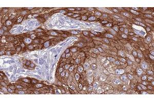 ABIN6277379 at 1/100 staining Human Head and neck cancer tissue by IHC-P. (GRK1 抗体  (N-Term))