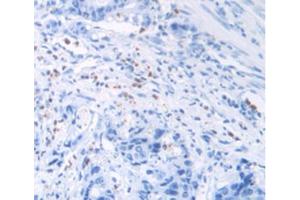 IHC-P analysis of Human Rectum Cancer Tissue, with DAB staining. (MUC2 抗体  (AA 5075-5179))