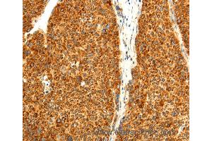 Immunohistochemistry of Human liver cancer using DIABLO Polyclonal Antibody at dilution of 1:50 (DIABLO 抗体)