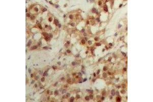 Immunohistochemical analysis of CBFB staining in human breast cancer formalin fixed paraffin embedded tissue section. (CBFB 抗体  (N-Term))