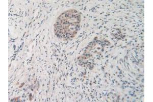 IHC-P analysis of Human Pancreas Cancer Tissue, with DAB staining. (MMP19 抗体  (AA 98-508))