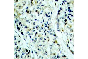 Immunohistochemistry of paraffin-embedded human breast carcinoma using Phospho-HDAC5-S498 antibody (ABIN2987596). (HDAC5 抗体  (pSer498))