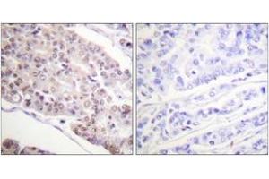 Immunohistochemistry analysis of paraffin-embedded human breast carcinoma tissue, using Histone H4 (Acetyl-Lys8) Antibody. (Histone H4 抗体  (acLys8))